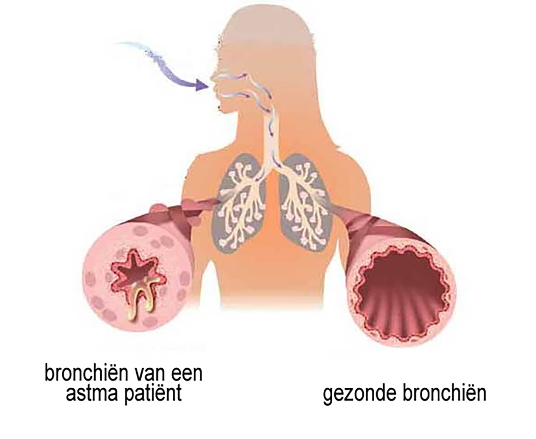 Buteyko methode en astma, gezonde en astma bronchien